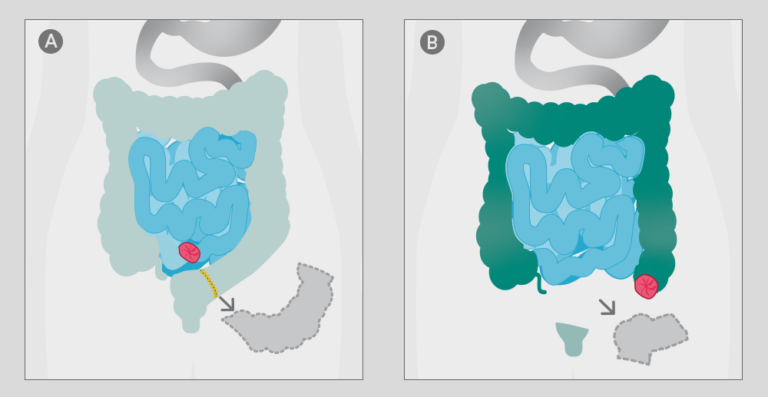 Stoma – Gut Zu Wissen: Welche Stomatypen Gibt Es? | Share To Care